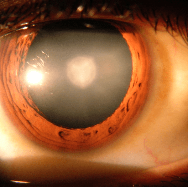 How the Brain Adjusts to Light After Cataract Surgery