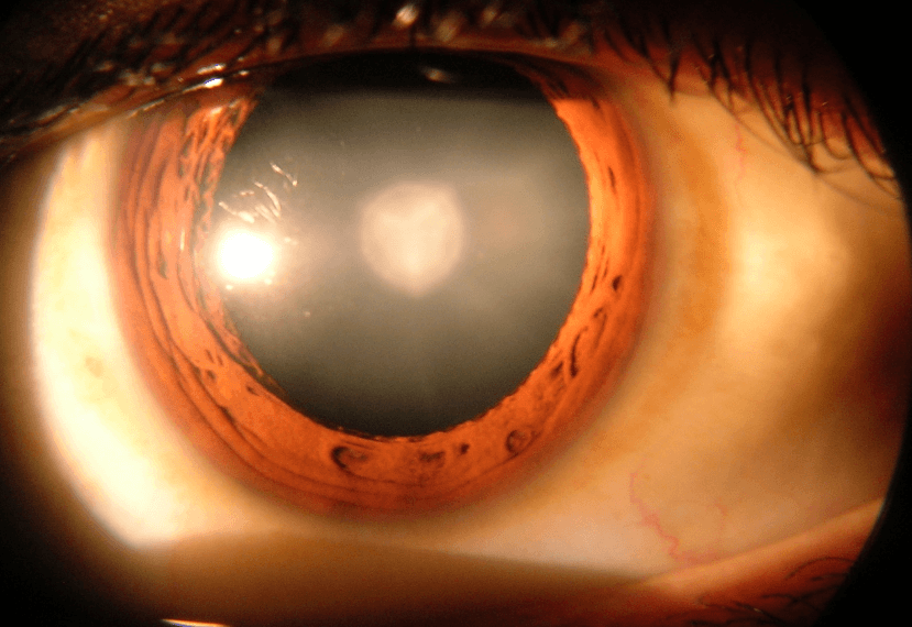 How the Brain Adjusts to Light After Cataract Surgery