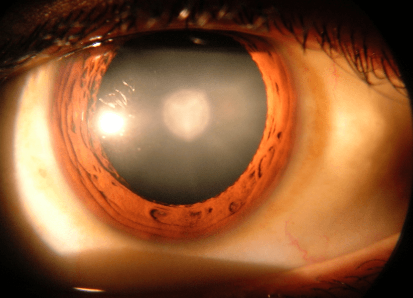 How the Brain Adjusts to Light After Cataract Surgery